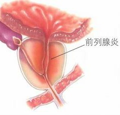 前列腺炎