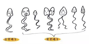 成都精子异常是怎么回事呢