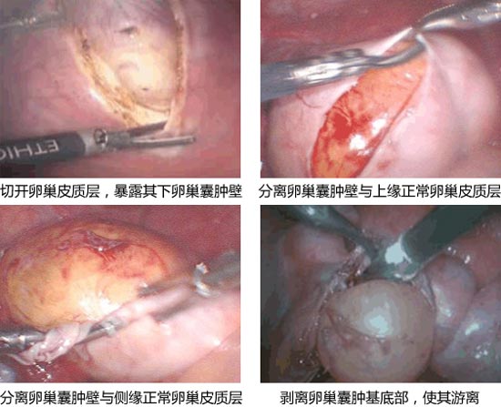 卵巢囊肿手术过程