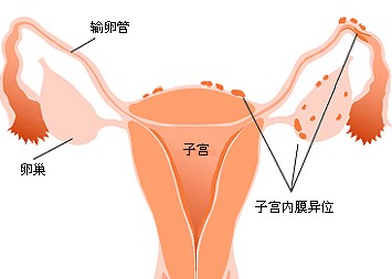 子宫内膜异位症