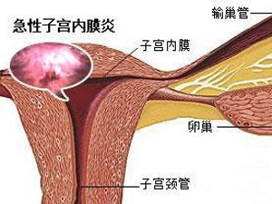 子宫内膜炎