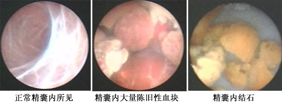 精囊镜诊治血精症
